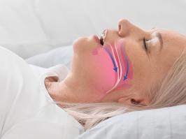 Mujer durmiendo con apnea obstructiva del sueño 