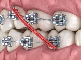 Elásticos intermaxilares en la ortodoncia  