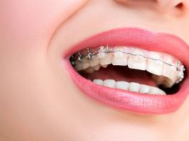 sonrisa de mujer con ortodoncia invisible