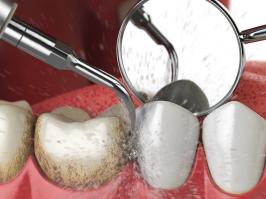 Procedimiento de profilaxis dental o Limpieza dental