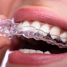 Férula de ortodoncia transparente siendo colocada sobre los dientes