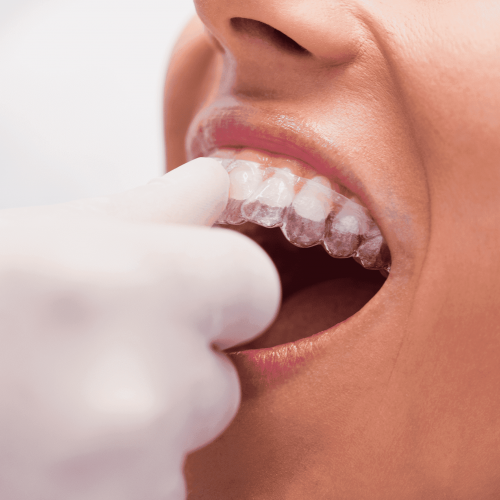 Los alineadores invisibles han llegado para revolucionar la ortodoncia tradicional