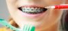 Sonrisa con brackets junto con cepillos especiales para el cuidado de la Ortodoncia